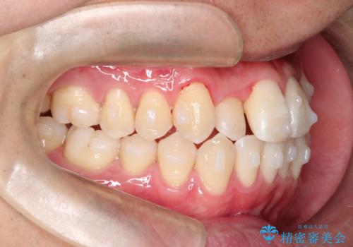 前歯のクロスバイトとガタつきをマウスピース矯正(インビザライン )で治療した症例の治療中