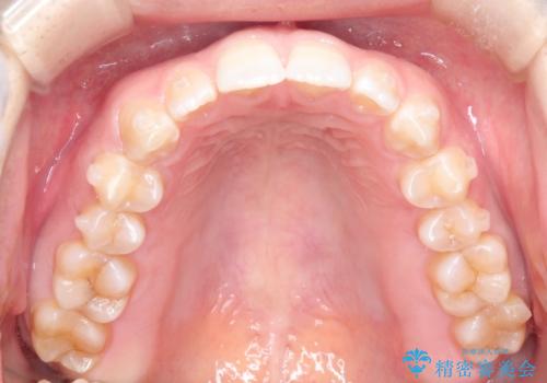 前歯の隙間を閉じたい インビザラインによる矯正の治療中