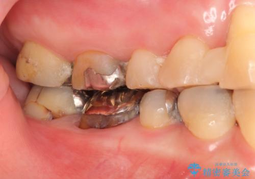 過度な咬合力 歯ぎしりで抜けた歯の欠損補綴の治療前