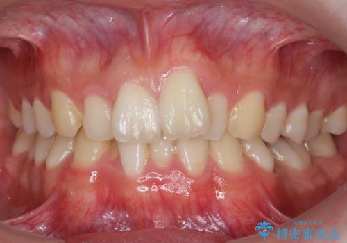 前歯のがたつき・すれちがい咬合を非抜歯で。流行の、格安マウスピースでは難しい、ワンランク上の治療の症例 治療前