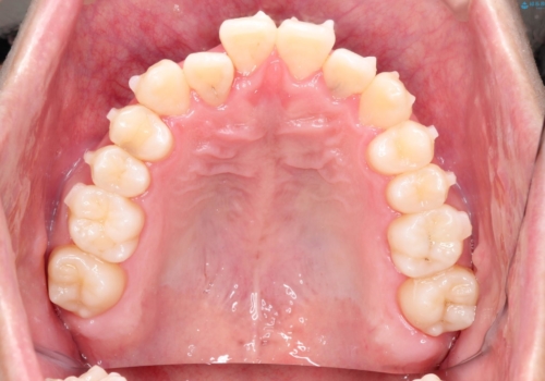 前歯のクロスバイトとガタつきをマウスピース矯正(インビザライン )で治療した症例の治療中