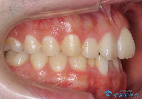 前歯のがたつき・すれちがい咬合を非抜歯で。流行の、格安マウスピースでは難しい、ワンランク上の治療の治療前