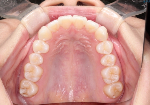 前歯の突出、深い噛み合わせ、ガタつきをマウスピース矯正(インビザライン)で治療した症例の治療後