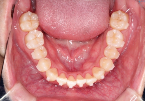 前歯のクロスバイトとガタつきをマウスピース矯正(インビザライン )で治療した症例の治療中