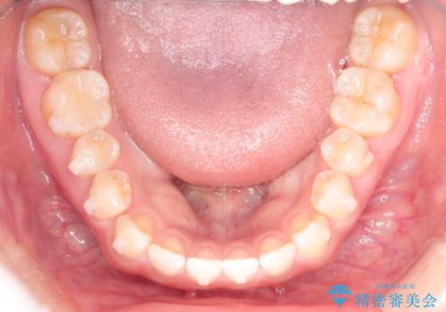 前歯の隙間を閉じたい インビザラインによる矯正の治療中