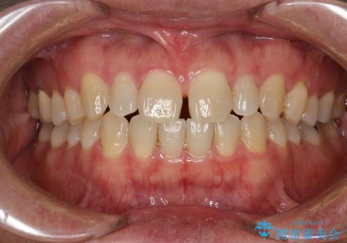 前歯の真ん中の隙間を閉じたい　インビザラインによる目立たない矯正の症例 治療前