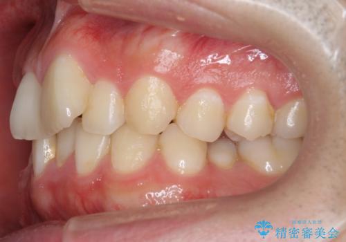 前歯のがたつき・すれちがい咬合を非抜歯で。流行の、格安マウスピースでは難しい、ワンランク上の治療の治療前