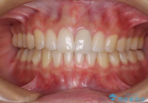 気になる前歯を治したい インビザライン矯正とオールセラミッククラウンの治療後