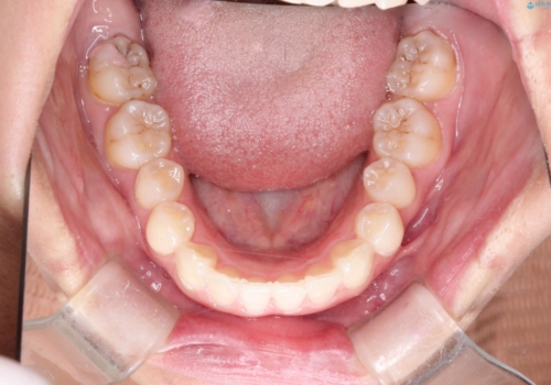 前歯の突出、深い噛み合わせ、ガタつきをマウスピース矯正(インビザライン)で治療した症例の治療後