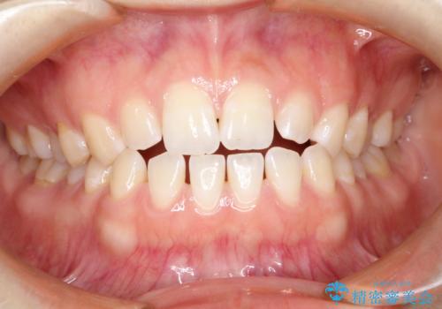 前歯の隙間を閉じたい　インビザラインによる矯正の症例 治療前