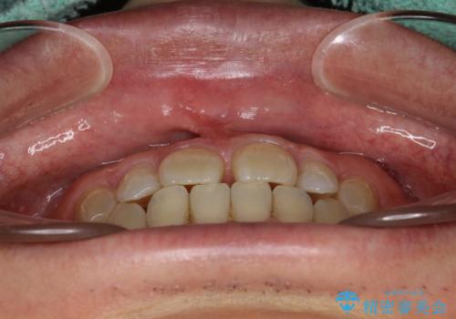 前歯の真ん中の隙間を閉じたい インビザラインによる目立たない矯正の治療前