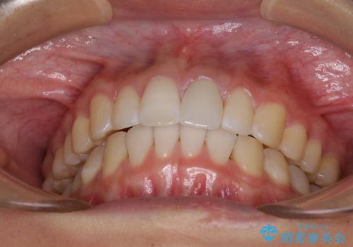 気になる前歯を治したい インビザライン矯正とオールセラミッククラウンの治療後