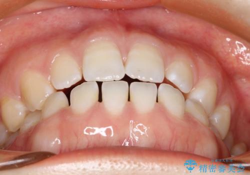 前歯の隙間を閉じたい インビザラインによる矯正の治療前