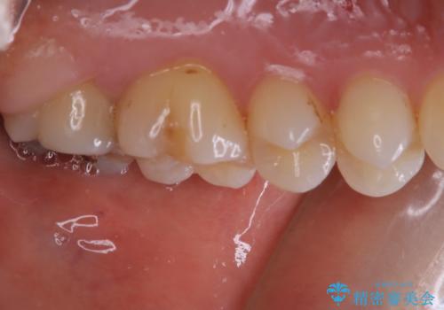 虫歯をセラミックで治療の治療前