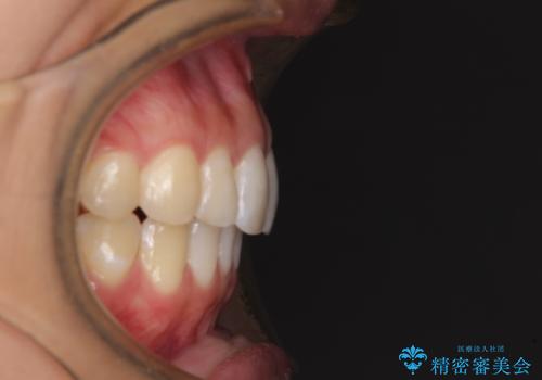 気になる前歯を治したい インビザライン矯正とオールセラミッククラウンの治療後