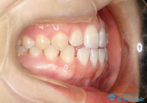 前歯の隙間を閉じたい インビザラインによる矯正の治療前