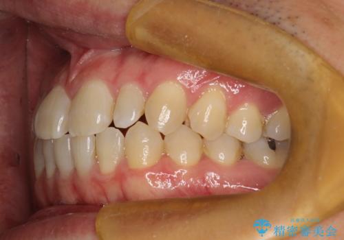 前歯の真ん中の隙間を閉じたい インビザラインによる目立たない矯正の治療前