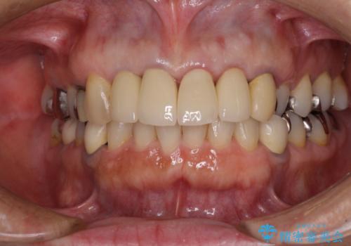 汚れてしまった保険のクラウン 前歯のオールセラミックの治療後