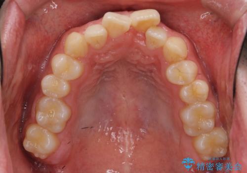 前歯のがたつき・すれちがい咬合を非抜歯で。流行の、格安マウスピースでは難しい、ワンランク上の治療の治療前