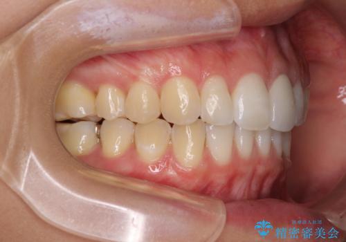 気になる前歯を治したい インビザライン矯正とオールセラミッククラウンの治療後