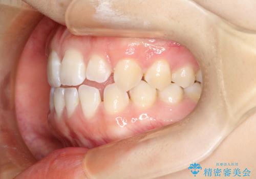 前歯の隙間を閉じたい インビザラインによる矯正の治療前