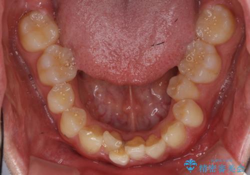 前歯のがたつき・すれちがい咬合を非抜歯で。流行の、格安マウスピースでは難しい、ワンランク上の治療の治療前