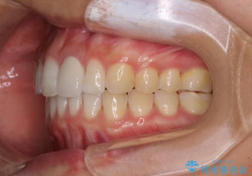 気になる前歯を治したい インビザライン矯正とオールセラミッククラウンの症例 治療後