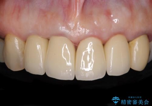 汚れてしまった保険のクラウン 前歯のオールセラミックの症例 治療後