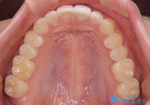 気になる前歯を治したい インビザライン矯正とオールセラミッククラウンの治療後