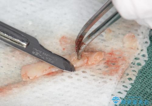 徐々に下がってきた歯肉へ再生療法(歯冠側移動術と結合組織移植術の併用)を施術し、丈夫な歯肉を獲得させた症例の治療中