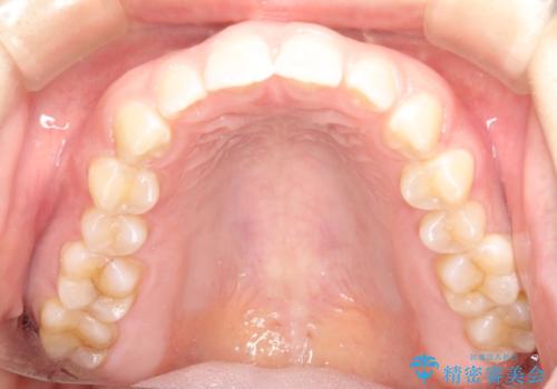 前歯の隙間を閉じたい インビザラインによる矯正の治療前