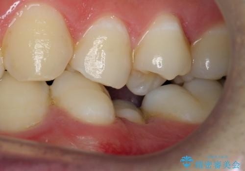 前歯のがたつき・すれちがい咬合を非抜歯で。流行の、格安マウスピースでは難しい、ワンランク上の治療