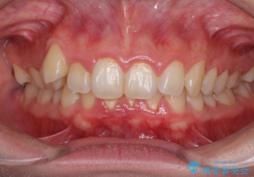 気になる八重歯を治したい インビザラインと補助装置を用いた抜歯治療の症例 治療前