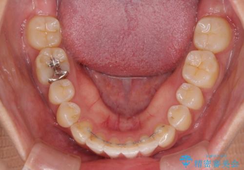 気になる前歯を治したい インビザライン矯正とオールセラミッククラウンの治療後