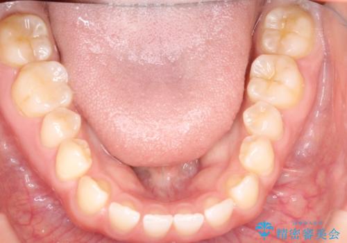 前歯の隙間を閉じたい　インビザラインによる矯正の治療前