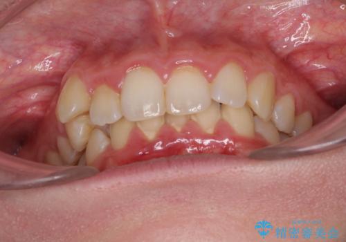気になる八重歯を治したい インビザラインと補助装置を用いた抜歯治療の治療前