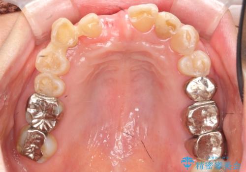 過度な咬合力 歯ぎしりで抜けた歯の欠損補綴の治療前