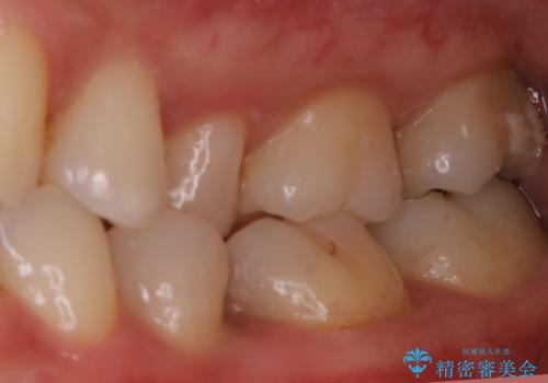 虫歯をセラミックで治療の治療前