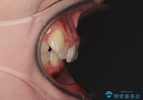 気になる八重歯を治したい インビザラインと補助装置を用いた抜歯治療の治療前