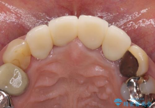 汚れてしまった保険のクラウン 前歯のオールセラミックの治療後
