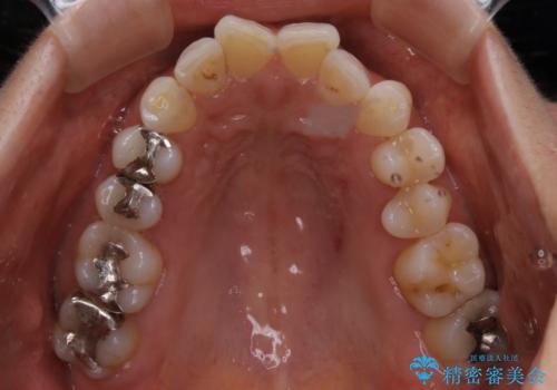 虫歯をセラミックで治療の治療前