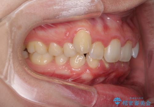 気になる八重歯を治したい インビザラインと補助装置を用いた抜歯治療の治療前