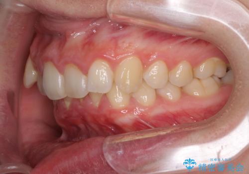気になる八重歯を治したい　インビザラインと補助装置を用いた抜歯治療の治療前