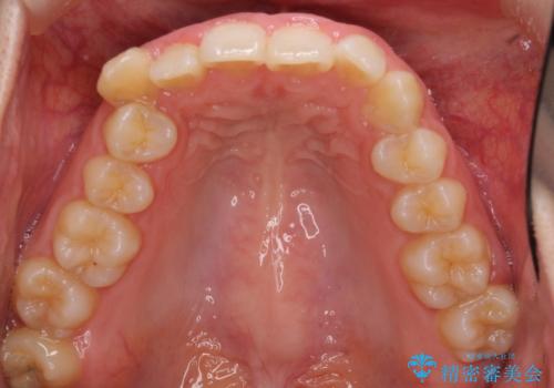 気になる八重歯を治したい インビザラインと補助装置を用いた抜歯治療の治療前