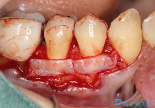 徐々に下がってきた歯肉へ再生療法(歯冠側移動術と結合組織移植術の併用)を施術し、丈夫な歯肉を獲得させた症例の治療前