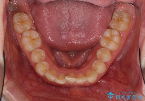 気になる八重歯を治したい インビザラインと補助装置を用いた抜歯治療の治療前