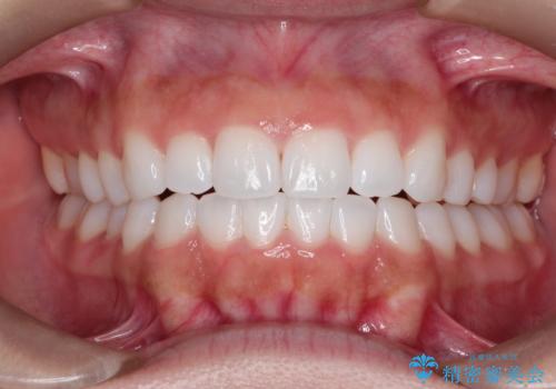 インビザラインを用いた叢生(歯並びのガタつき)の治療の症例 治療後