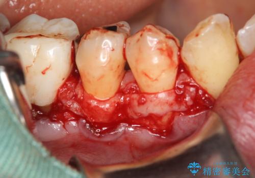 徐々に下がってきた歯肉へ再生療法(歯冠側移動術と結合組織移植術の併用)を施術し、丈夫な歯肉を獲得させた症例の治療中