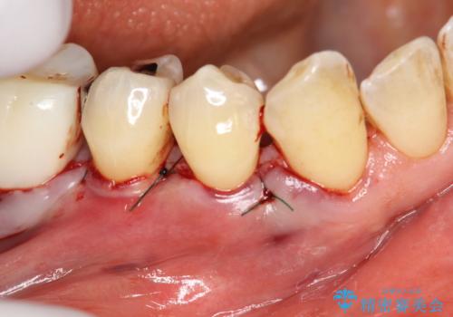 徐々に下がってきた歯肉へ再生療法(歯冠側移動術と結合組織移植術の併用)を施術し、丈夫な歯肉を獲得させた症例の治療後