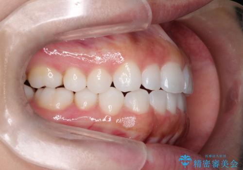 インビザラインを用いた叢生(歯並びのガタつき)の治療の治療後